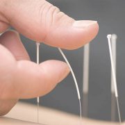 acupuncture_needles