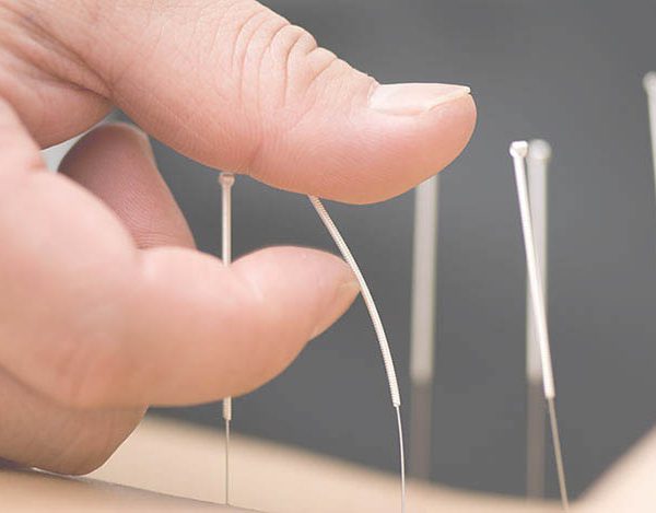 acupuncture_needles